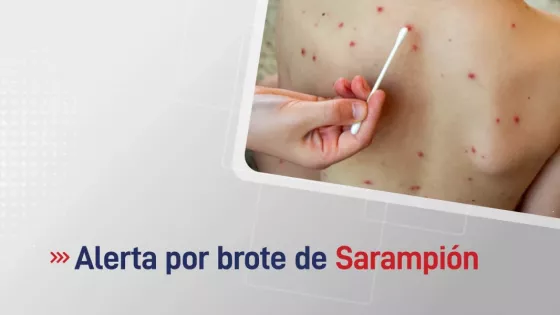 Recomendaciones ante la alerta epidemiológica por sarampión en el país