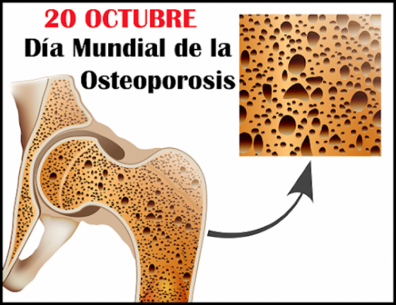 Dieta saludable y actividad física previenen la osteoporosis