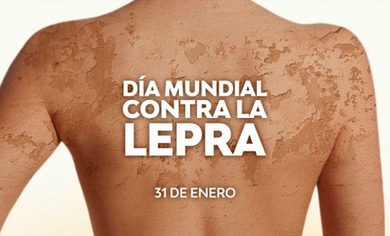 La lepra no es hereditaria y se cura con tratamiento ambulatorio