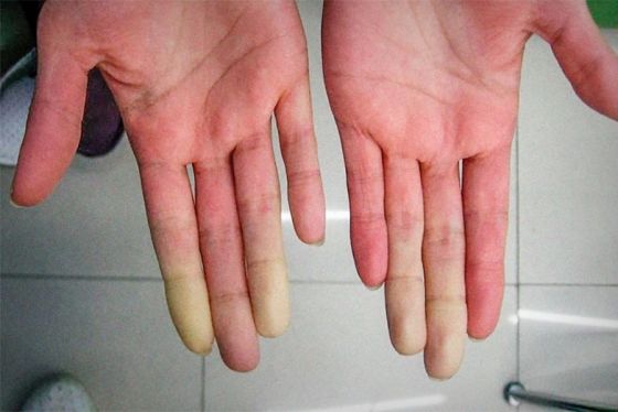 El hospital Señor del Milagro es referente del Fenómeno de Raynaud