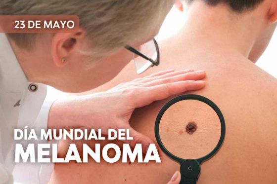 El melanoma es un cáncer de piel curable si se lo diagnostica a tiempo