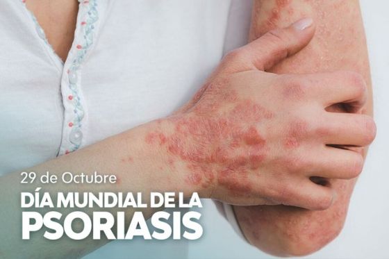 La psoriasis no es contagiosa y se puede controlar con tratamiento médico