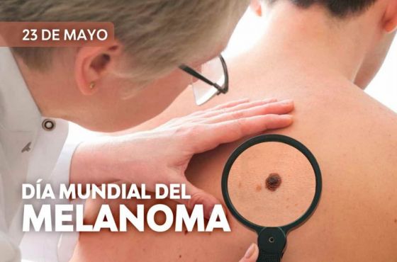 El melanoma es un cáncer de piel altamente curable si se diagnostica a tiempo