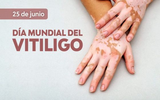 El vitiligo es una enfermedad que no se contagia ni se hereda