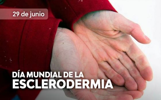 Harán diagnóstico de esclerodermia en el hospital Señor del Milagro