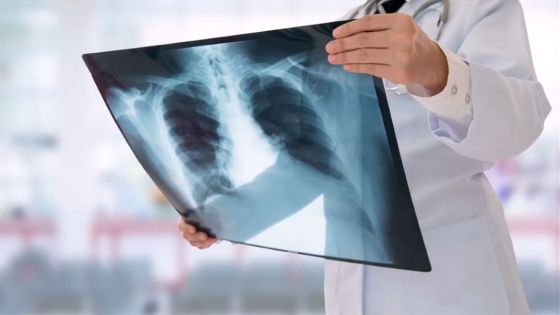 La tuberculosis es la enfermedad infecciosa que más muertes ocasiona a nivel mundial