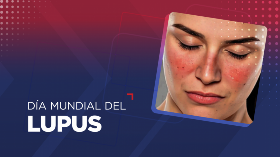 El lupus es una enfermedad de difícil diagnóstico y aún no tiene cura