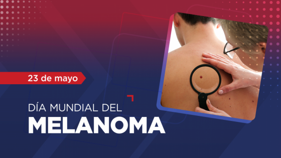 El melanoma es un cáncer de piel altamente curable si es detectado y tratado a tiempo