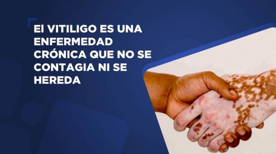 El vitiligo es una enfermedad crónica que no se contagia ni se hereda