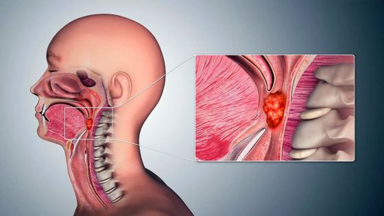 El alcohol y el tabaco favorecen el desarrollo de cánceres de cabeza y cuello