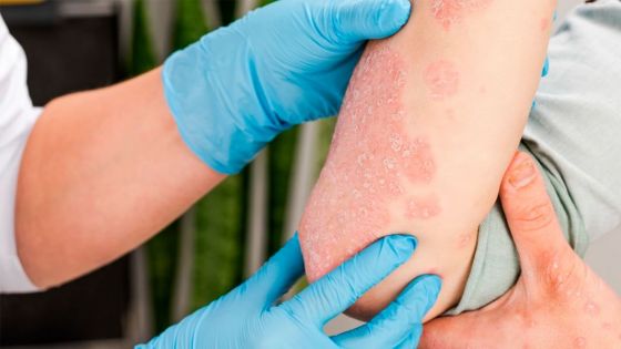 Realizarán hoy una campaña de detección de psoriasis en el hospital San Bernardo