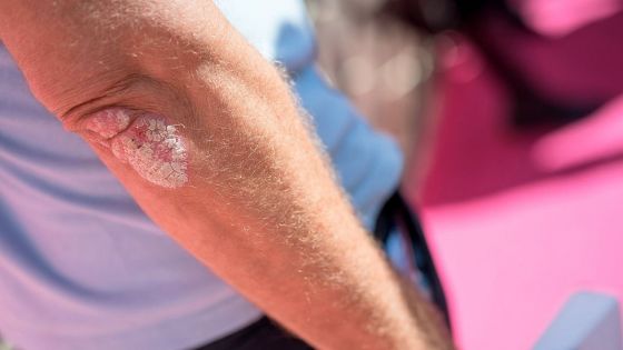 Aunque la psoriasis no tiene cura se puede controlar con tratamiento